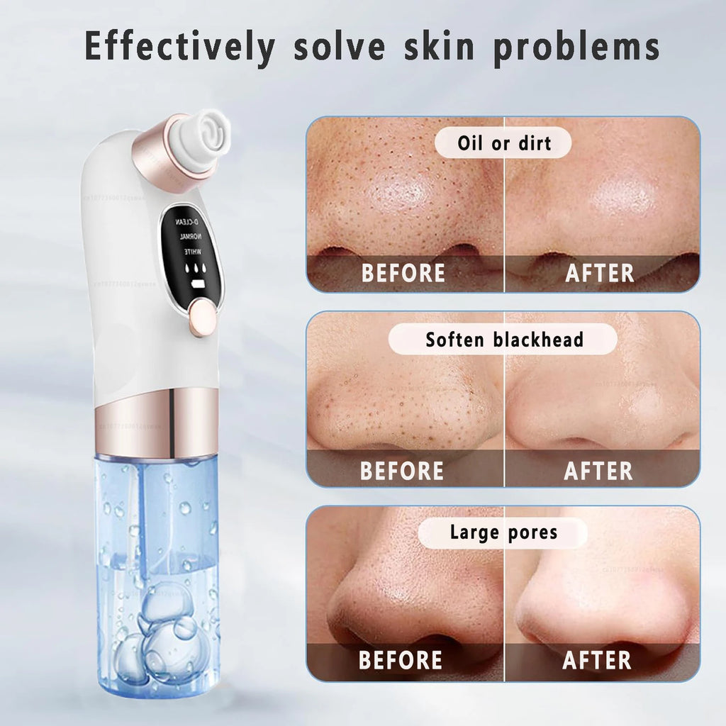 LAQTA blackhead remover tool with stainless steel tip for facial pore extraction, shown in a close-up image.