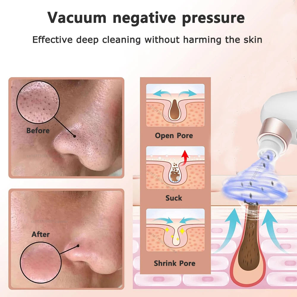 LAQTA blackhead remover device with multiple attachments, designed for deep cleansing and pore extraction.